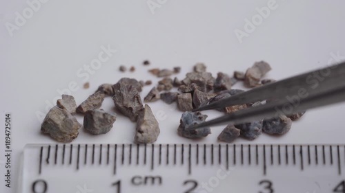 Fragments of a kidney stone crushed by ultrasound with a diameter of 1.5 centimeters