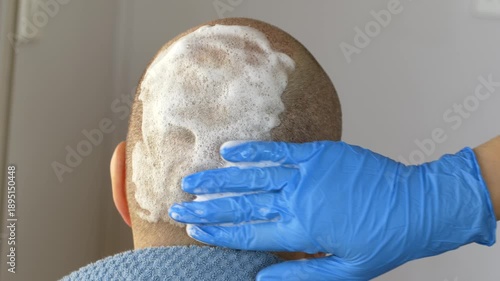 Doctor performs therapeutic scalp cleansing with medical foam after hair transplantation. Gentle shampoo treatment supports faster healing, reduces irritation, protects grafts during recovery phase