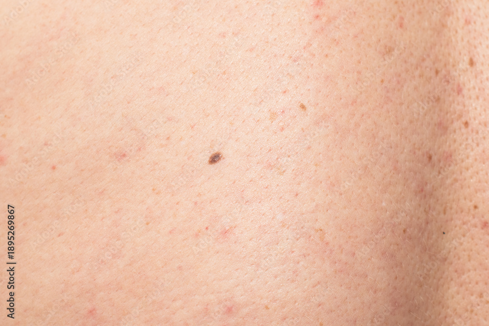 Fototapeta premium Closeup of human skin with mole and slight redness texture