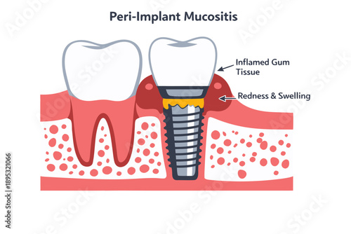 Peri-Implant Mucositis Dental Cross-Section 2D Flat Vector
