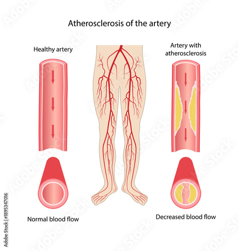 Atherosclerosis of arteries. Medical illustration of longitudinal and cross-section of healthy artery and an artery affected by atherosclerosis. Vector illustration in flat style on white background
