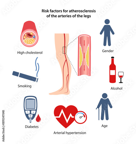 Risk factors for atherosclerosis of the leg arteries. Medical illustration of an artery affected by atherosclerosis. Vector illustration in flat style on a white background.