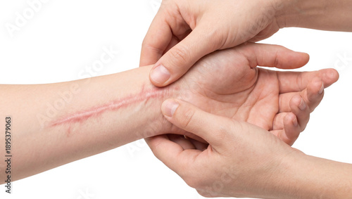 Close-Up of Healed Scar on Human Wrist isolated on White or transparent background