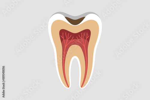Simplified anatomical drawing of a human molar tooth depicting internal structure and a dental cavity