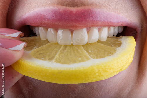 Quadro em tela Close up of female teeth biting lemon slice showing ceramic veneers and natural