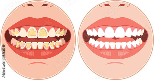 Dental health comparison illustration showing unhealthy stained teeth versus clean white teeth, highlighting oral hygiene improvement, care, and professional treatment results