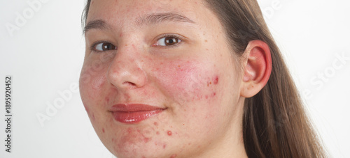 Foto Pimple on face