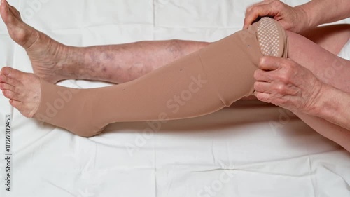 Hands pulling compression stocking onto swollen leg lymphedema aid use
