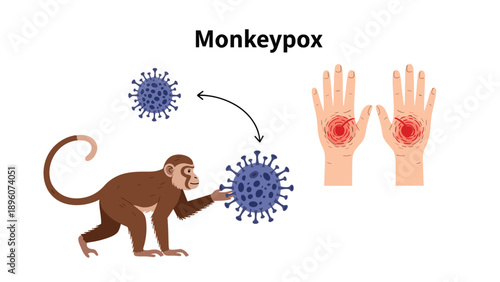 Educational graphic about monkeypox showing a monkey virus particles and human hands with characteristic red skin rashes.