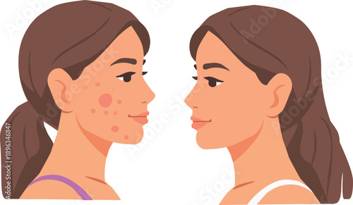 Acne Before and After Face Treatment Comparison Vector Illustration