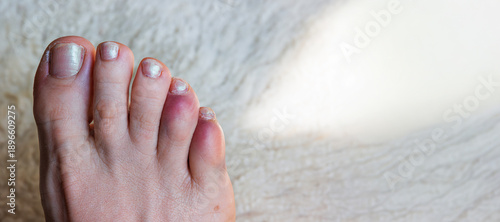 Cuadro en lienzo Close up of a bare foot with a broken or sprained bruised reddened toes phalanges