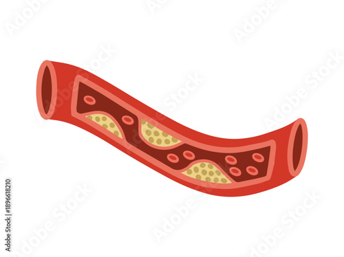 Blood Vessel or Artery with Cholesterol