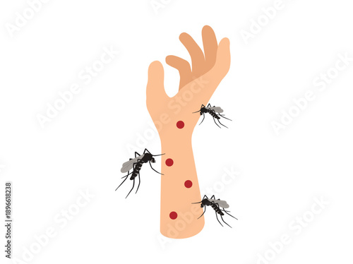Mosquito Bite in Hand Skin

