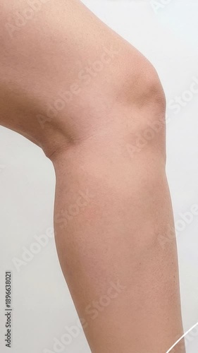 Before and After Treatment of Varicose Veins on Smooth Legs with Visible Swelling