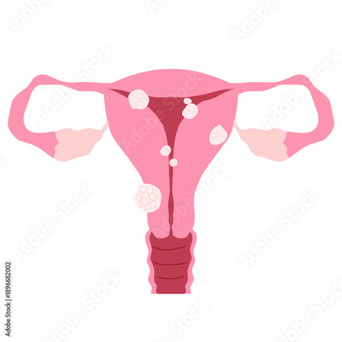 Female Reproductive System with Uterine Fibroid Illustration. Ovary disease 