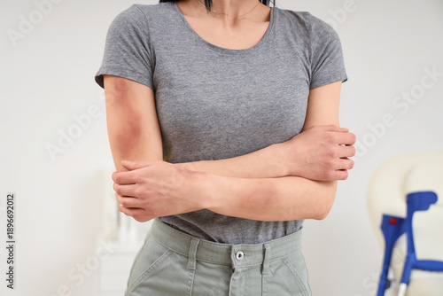 Young woman with bruised ar...