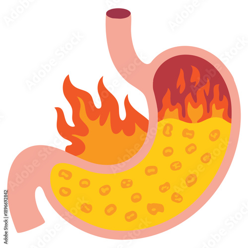Flat design illustration of human stomach on fire on white background showing heartburn concept acid reflux disease digestion problem and health issue representation