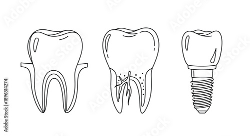 Set of dental diagrams illustrating a healthy molar, a tooth with an infected root canal, and a modern dental implant.