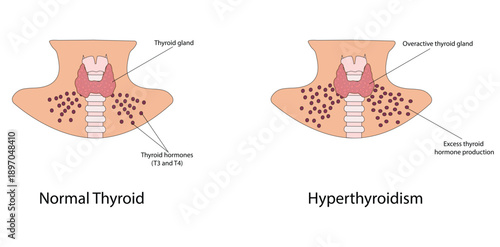 Hyperthyroidism vector illustration
