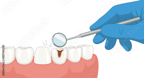 Dentist's hand using a dental mirror to examine a tooth with a cavity, illustrating dental health and caries treatment.