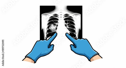 Two gloved hands point at a chest x-ray showing lungs with a noticeable abnormality
