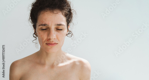 Foto Portrait of young female with pimples and acne on face in close-up on white isolated background