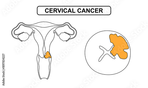 Cervical Cancer Illustration Concept, the growth of cancer cells in the cervix. vector drawing illustration for medical, education, science, and the concept of disease in reproductive organs.