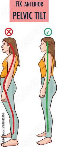 Anterior pelvic tilt or APT as pelvis abnormal posture outline diagram stock illustration Illustrator Artwork