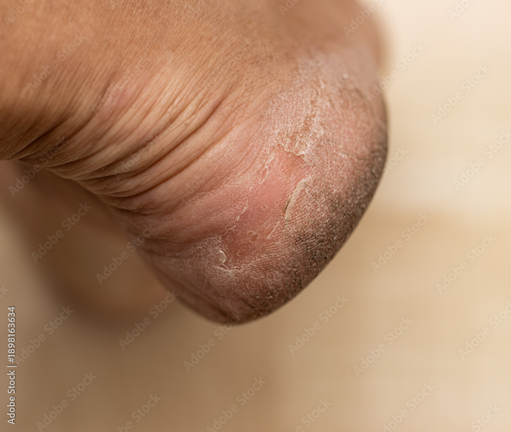 Naklejka premium A person's foot with a callus on the bottom