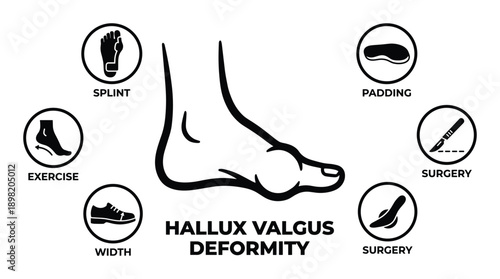 Hallux Valgus Deformity Treatment Vector Illustration: splint, padding, exercise, surgery, and shoe width solutions