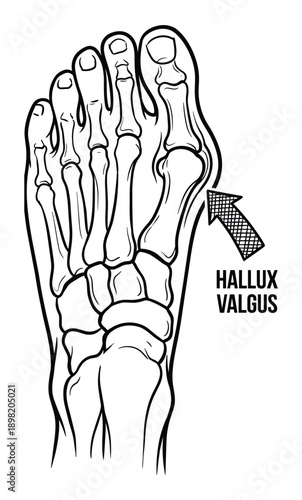 Hallux Valgus Foot Bone Anatomy Illustration, Foot Deformity Skeletal Structure, Medical Condition
