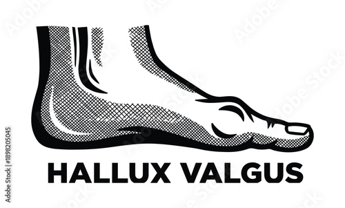 Hallux Valgus foot illustration, medical condition of the big toe bending towards the other toes