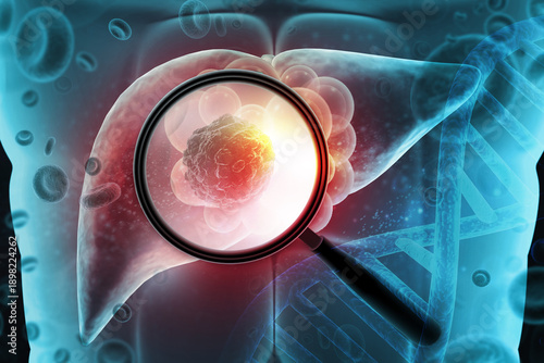 A medical concept illustration featuring a magnifying glass focusing on a malignant tumor within a human liver, emphasizing early oncological diagnosis and hepatic pathology. 3d illustration