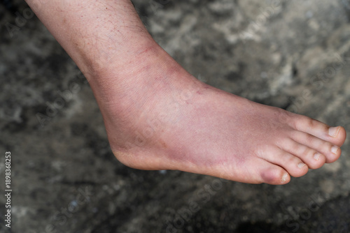 Photos Swollen Foot After Cast Removal of Metatarsal Fracture