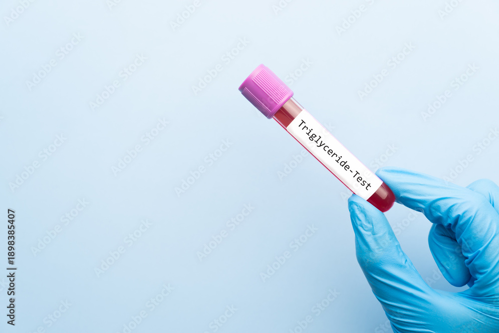 Fototapeta premium Blood sample tube with triglyceride cholesterol test label on medical laboratory technologist hands over blue background.