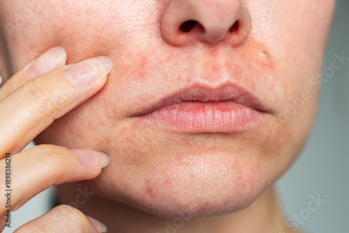 Konstfotografi Close-up photo of the face of a young Caucasian woman suffering from perioral dermatitis near the mouth