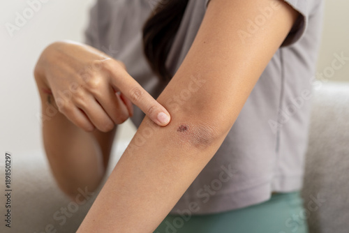 Tableau sur toile Close-up of women pointing at scabbed wound on elbow, showing skin injury, healing process or infection concern