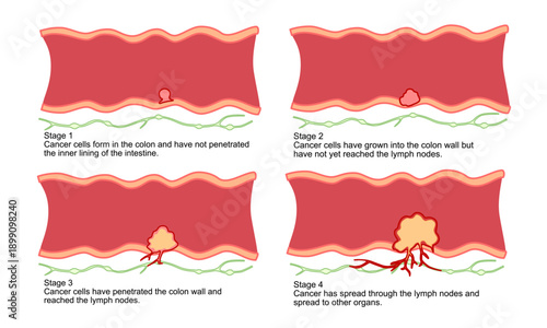 Illustration of colorectal cancer stages. Concept of colon cancer progression. Spread of tumor to lymph nodes. Flat vector illustration for clinics, education, and science.