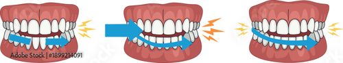 Dental illustration showing human teeth grinding and jaw clenching symptoms of bruxism with blue arrows and orange pain signals isolated