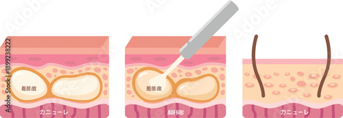 Illustration of Liposuction Procedure Showing Cannula Removing Subcutaneous Fat Cells From Under the Skin Layers for Medical and Cosmetic Surgery