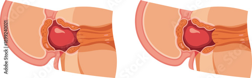 Medical Illustration of Hiatal Hernia Showing Stomach Protruding Through Diaphragm Muscle into Chest Cavity for Healthcare Education and Surgical Diagnosis Poster
