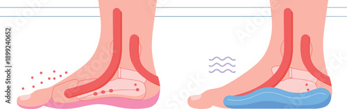 Medical Illustration of Orthopedic Insoles and Arch Support Inserts Providing Relief for Flat Feet Pain and Plantar Fasciitis in Human Anatomy