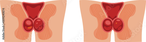 Medical Illustration of Inguinal Hernia Types and Male Anatomy Showing Intestine Protrusion Through Abdominal Muscle Wall for Surgical and Educational Use