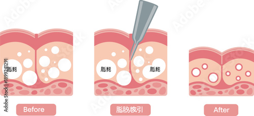 Medical vector illustration of liposuction surgery mechanism showing before and after fat removal process with subcutaneous skin cross section diagram