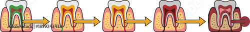 Progressive stages of tooth decay diagram showing dental caries reaching the pulp leading to a painful gum abscess and infection
