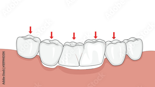 Dental medical diagram showing a set of human teeth with red arrows pointing down at specific molars to illustrate alignment or decay issues.