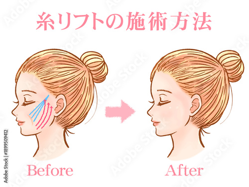 美容整形で糸リフト受ける大人女性の素材2