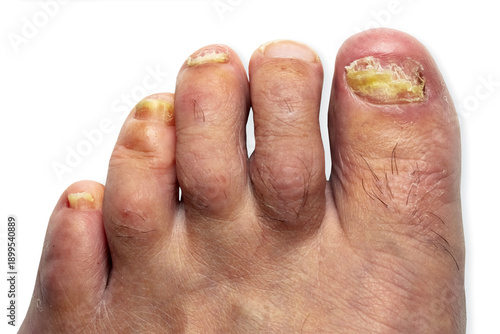 toenail fungus with onychomycosis at peak Infection in fungal foot nail
