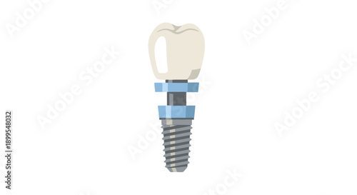 Dental implant illustration with tooth and abutment on white background from front view