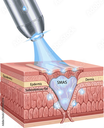 Create a realistic HIFU laser targeting SMAS layer for skin tightening and facelift 3D vector art white background.